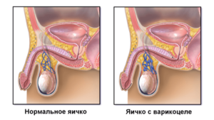 Болит яичко