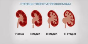 Пиелоэктазия у ребёнка