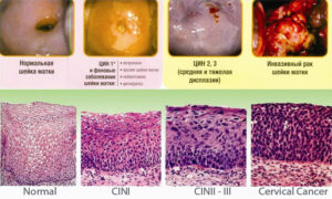 Легкая дисплазия и впч 16,31,33,35,52,58