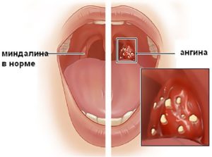 Кандидоз миндалин