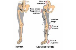 Болит поясница и плоскостопие