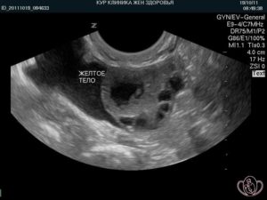 Киста желтого тела на 5 день цикла 19 мм