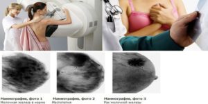 Маммография на 14 день цикла
