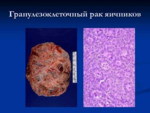 Киста яичника или гранулезоклеточная опухоль