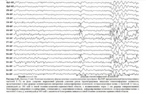 Изменения у ребенка ЭЭГ с элементами эпилептиформной активности