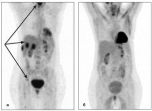 Лимфома. Расшифровка диагноза после ПЭТ/КТ исследования