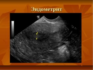 Планирование беременности и хр. Эндометрит+гипоплазия эндометрия