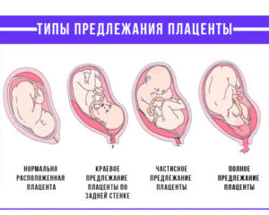 Коленно-локтевая поза и краевое предлежание плаценты