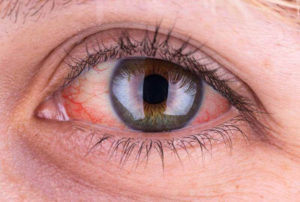 Кровоизлияние в глаз при коньюктивите