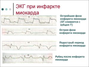 Инфаркт миокарда на ногах, расшифровка ЭКГ