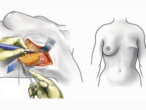 Изменилась форма груди после удаления фиброаденомы