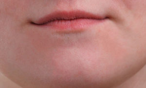 Красные мелкие точки на верхней губе и подбородке