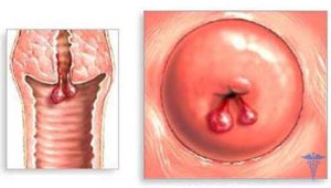 Конизация шейки матки и киста копчика