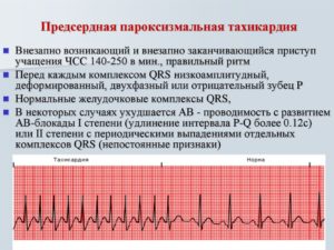 Как может влиять бисопролол на кардиограмму