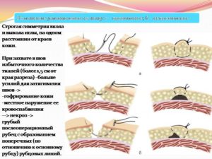 Консультация по качеству заживления шва