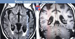 Кисты сосудистого сплетения левого бокового желудочка головного мозга плода