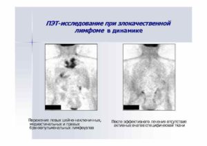 Лимфома. Расшифровка диагноза после ПЭТ/КТ исследования