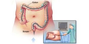 Боли в животе после колоноскопии