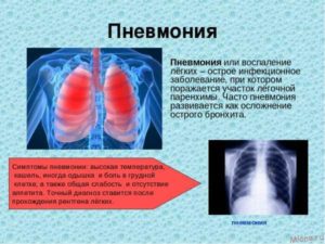 Кашель после пневмонии