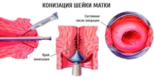 Конизация шейки матки и киста копчика