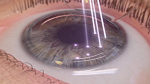 Как улучшится зрение после снятия швов с глаз