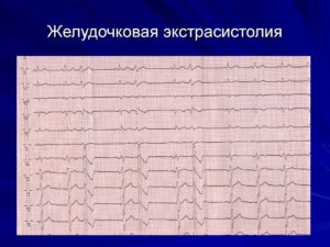 Частая желудочковая экстрасистолия