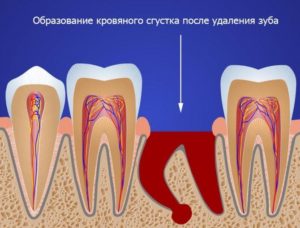 Болят соседние зубы после удаления