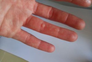 Болячки на суставах пальцев