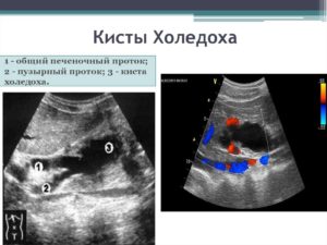 Киста холедоха после рождения