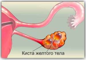 Киста жёлтого тела при приеме утрожестан