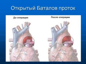 Кальцинат связки Баталова протока