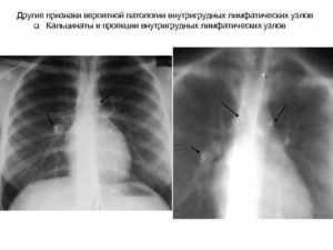 Кальцинаты лимфоузла лёгкого у ребенка