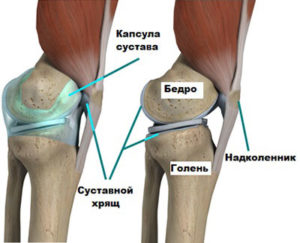 Лопнула суставная капсула