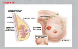 Карцинома 3в стадии или нет