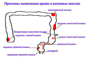 Кровь в кале после удаления геморроя