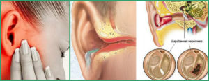 Болит ухо при Беременности