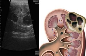 Киста в обеих почках