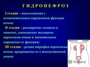 Пиелоэктазия у ребёнка