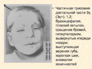 Частичная трисомия