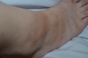 Красные пятна в складках на ножках и других частях тела