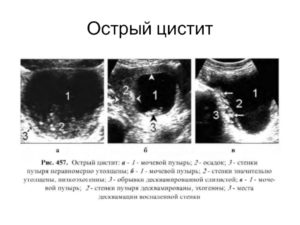 Боли в области почки при полном мочевом пузыре