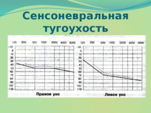 Левосторонняя сенсоневральная тугоухость 1-й степени