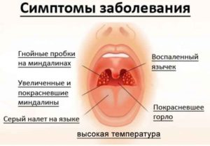 Хронический тонзиллит и постоянные простуды