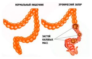 Каловый завал, хронический запор. Ребёнку 12лет