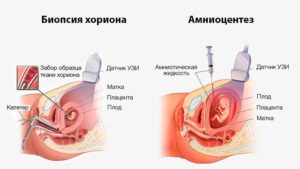 Как расшифровать кариотип плода 45[2]/46[7] делали биопсию хориона