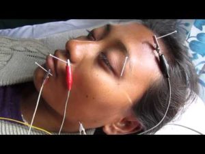 Иглоукалывание при парезе лицевого нерва