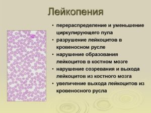 Лейкопения