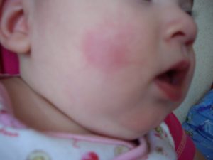 Красное уплотнение на щеке у ребенка
