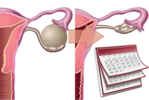 Киста яичника и месячные