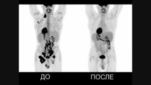 Лимфома. Расшифровка диагноза после ПЭТ/КТ исследования